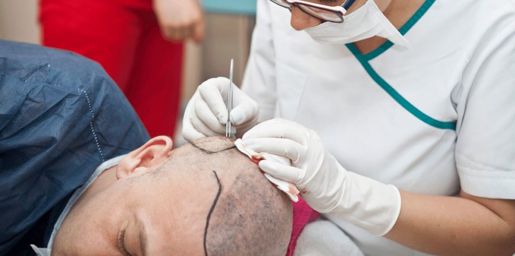hair transplant